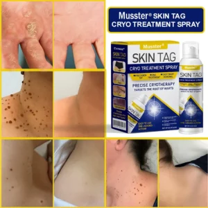 Musster Skin Tag Cryo Treatment Spray